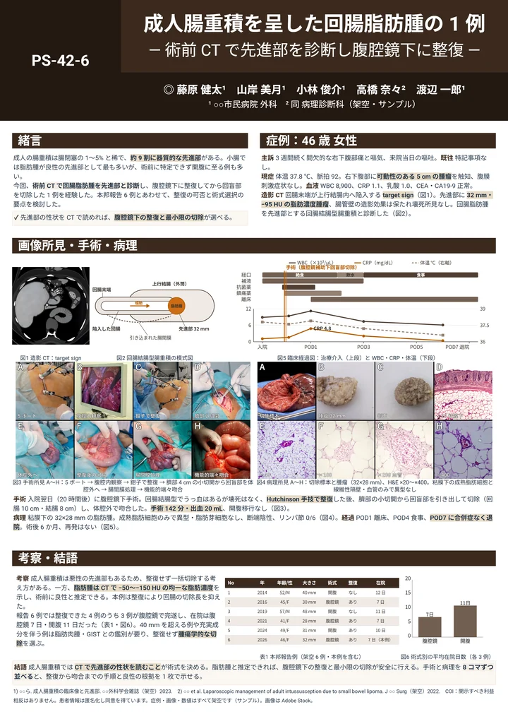 回腸脂肪腫の症例報告をZ型で組んだポスター作例(手術・病理 各8コマ)