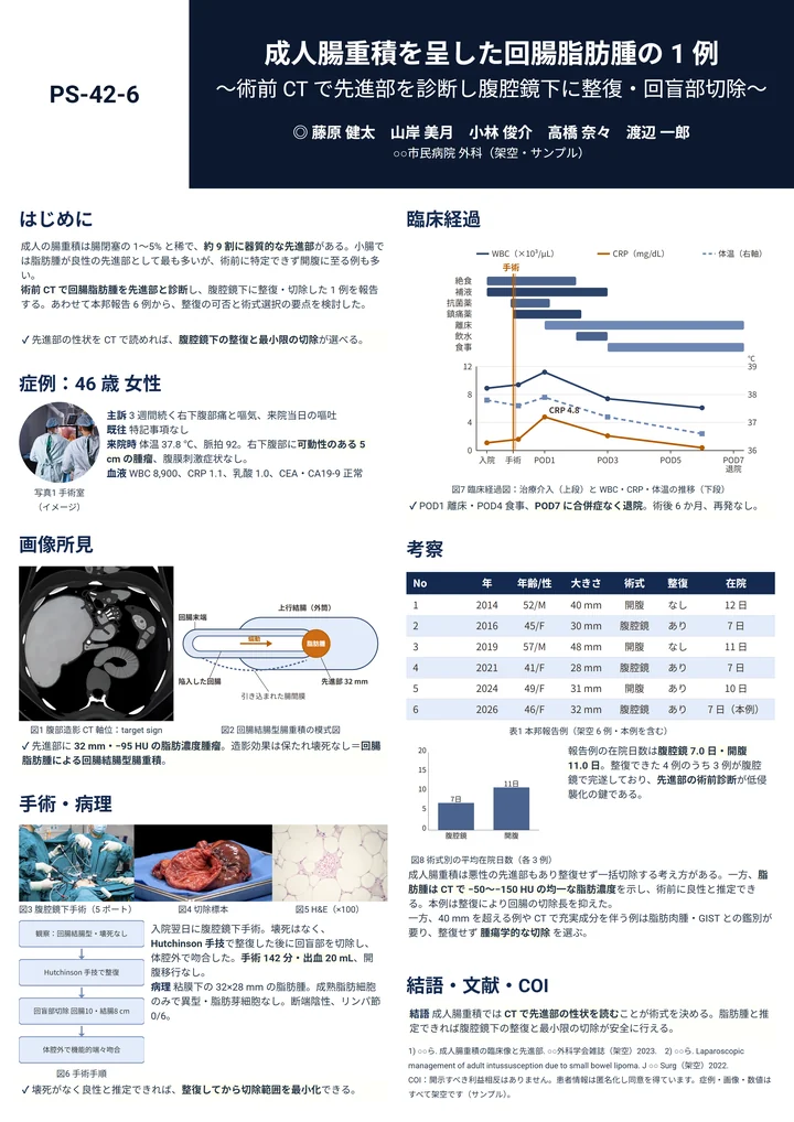 成人腸重積を呈した回腸脂肪腫に腹腔鏡下回盲部切除を行った症例報告ポスター作例