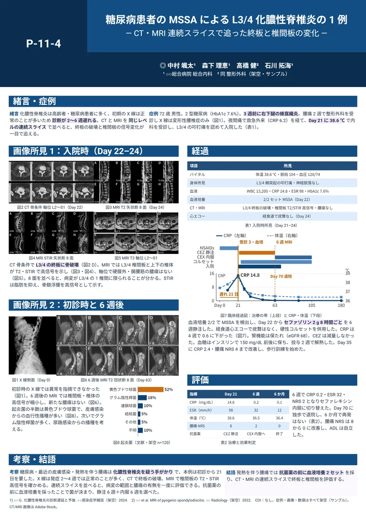 糖尿病患者のMSSAによる化膿性脊椎炎の症例報告ポスター作例