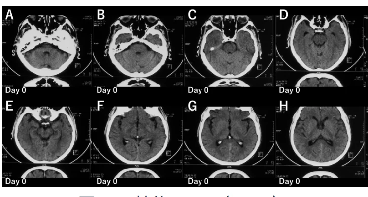 画像所見の一部(CT 軸位 A〜H・Day 0)。紙面ではこの8コマが幅190mmに並ぶ