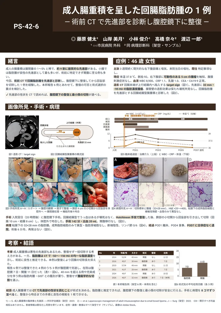 成人腸重積を呈した回腸脂肪腫の 1 例（症例報告・A0 縦・Z 型 2－1－1の作例）