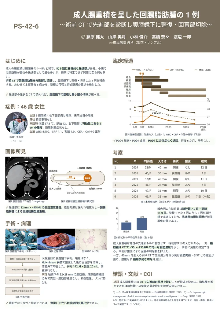 成人腸重積を呈した回腸脂肪腫の 1 例（症例報告・A0 縦・縦2列の作例）