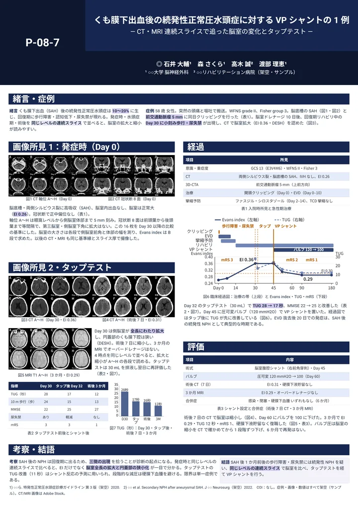 くも膜下出血後の続発性正常圧水頭症に対する VP シャントの 1 例（症例報告・A0 縦・Z 型 1－2－1の作例）