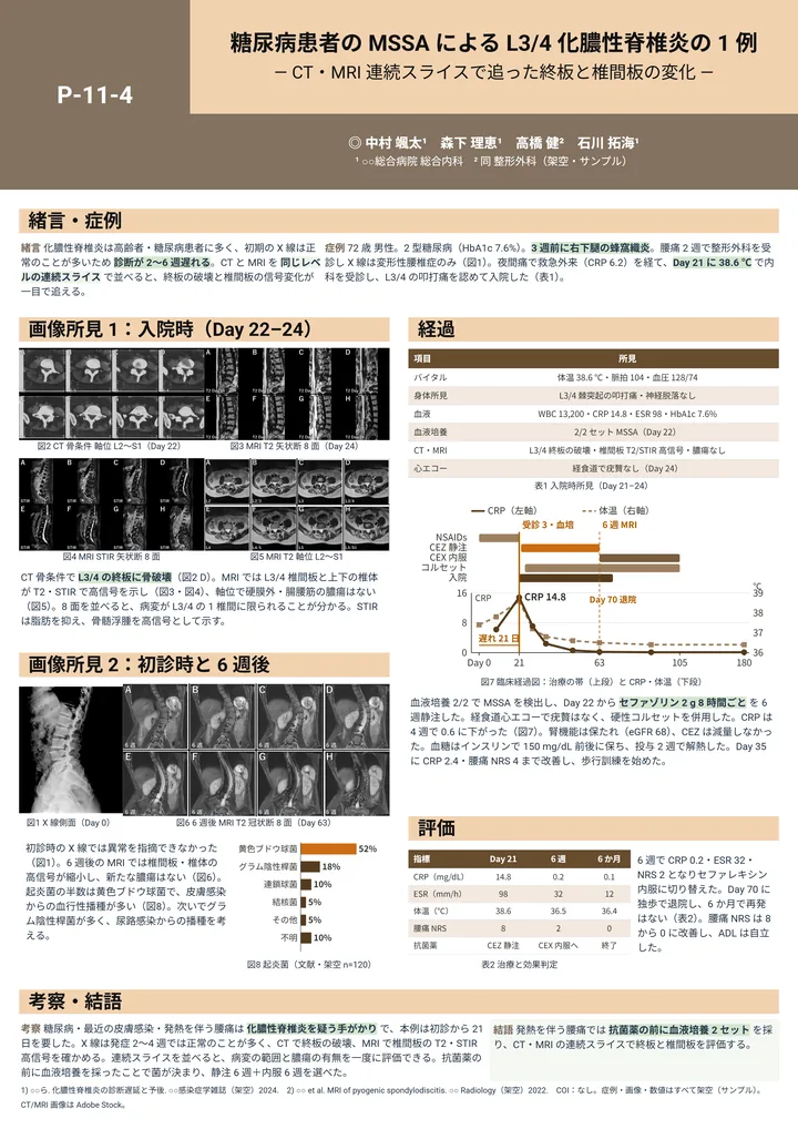 糖尿病患者の MSSA による L3/4 化膿性脊椎炎の 1 例（症例報告・A0 縦・Z 型 1－2－1の作例）